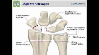 0716  Begleitverletzungen der distalen Radiusfraktur [upl. by Ynnatirb181]