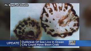 Ocean City Sea Lice Are Actually Baby Crabs [upl. by Merrile]