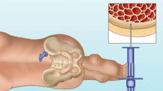 NiemannPick disease Type C  causes symptoms diagnosis treatment pathology [upl. by Tigirb]