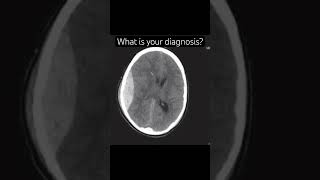 Epidural hematoma neurology brain neuroscience stroke epidural medstudent biology [upl. by Alvira]