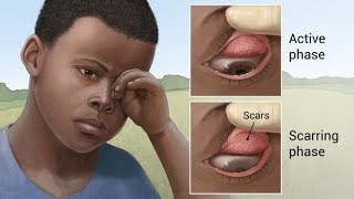 Trachoma  a very common infectious eye disease [upl. by Leiruh]