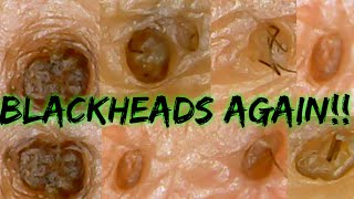 Blackheads Removal on the back [upl. by Oruntha]