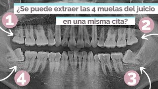 ¿SE PUEDEN EXTRAER LAS 4 MUELAS DEL JUICIO EN UNA MISMA CITA [upl. by Honorine]