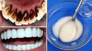 How To Whiten Teeth In 2 Minutes  Removes Tartar And Black Teeth Without Dentist [upl. by Aleehs]