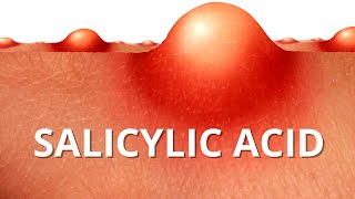 Heres WHY Salicylic Acid is Best For ACNE [upl. by Hildebrandt]