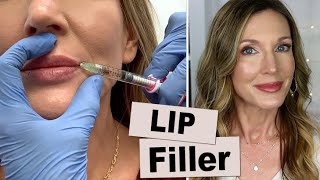 My Experience Getting Lip Filler for Vertical Wrinkles [upl. by Nomed]