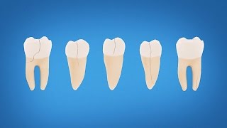 Understanding Cracked Tooth Treatment and Symptoms [upl. by Ddej]