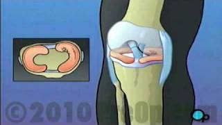 Anterior Cruciate Ligament Arthroscopic Repair PreOp® Patient Education [upl. by Akirea]