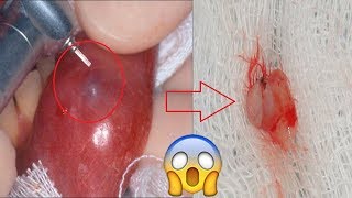 Home Remedies To Get Rid Of Mucocele Mucous Cyst For Good [upl. by Ariel829]