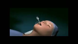 how to perform Tracheostomy tube ETT [upl. by Parnas134]