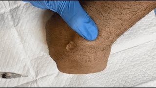 Drainage of a Ganglion Cyst [upl. by Yllas569]