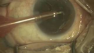 Typical Cataract Surgery Part 2 of 4 [upl. by Chivers]