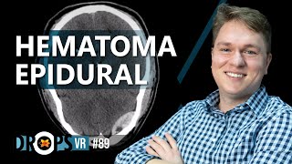 HEMATOMA EPIDURAL  COMO ACONTECE E COMO IDENTIFICAR [upl. by Yorle]