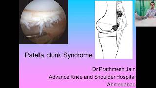 Chondromalacia Patella Treatment  Prolotherapy [upl. by Durno727]