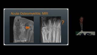 Imaging of Osteomyelitis amp Septic Arthritis  15 Minute Radiology CME [upl. by Anailil698]