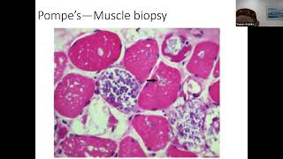 Metabolic myopathies Dr Y Anziska [upl. by Krishna794]