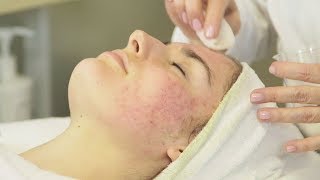 Acne Analysis And Treatment Part 1 [upl. by Benedick]