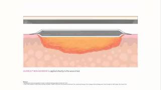 SILVERCEL™ NONADHERENT Antimicrobial Alginate Dressing with EasyLIFT™ Precision Film Technology [upl. by Margherita26]