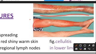 Cellulitis [upl. by Armalla]