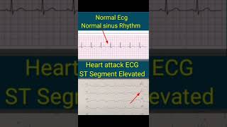 HEART ATTACK on ECG VS NORMAL ECG  You wont believe [upl. by Folly]