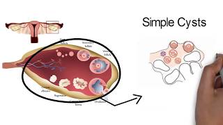 OVARIAN CYSTSwhat you need to know [upl. by Ettenrahs]