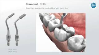 Preparation rules for ceramic inlays and partial crowns [upl. by Drhcir]