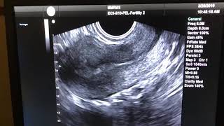 Transvaginal Ultrasound [upl. by Boor152]