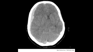 HEMATOMA SUBDURAL CAUSAS SÍNTOMAS Y TRATAMIENTO CLAVES DIAGNÓSTICAS [upl. by Carlynne921]