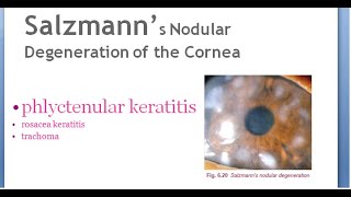 Ophthalmology Salzmann nodular degeneration of cornea phlyctenular rosacea keratitis trachoma [upl. by Nerha419]