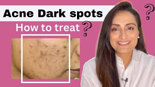 BEST Treatments for Acne Scars [upl. by Ul]