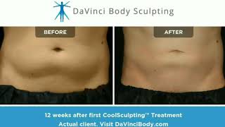 Amazing CoolSculpting Before and After Results  Abdomen [upl. by Broddie]