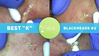 quotKsquot Best Blackhead Extraction Compilation Part 2 [upl. by Sunderland]