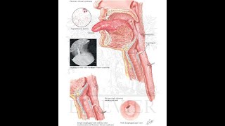 Plummer Vinson Syndrome [upl. by Brittne]