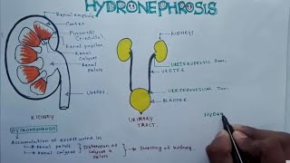 HYDRONEPHROSIS  Pathophysiology Causes signs and symptoms background diagnosis and treatment [upl. by Annawoj]