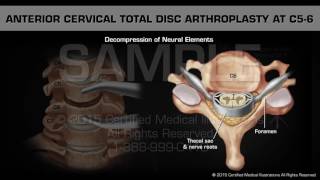 Anterior Cervical Total Disc Arthroplasty at C56 [upl. by Erastus]