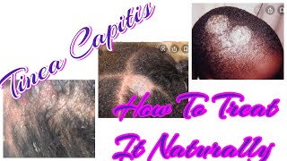 Tinea Capitis How To Treat It Naturally Diagnosedupdatetreatment [upl. by Isdnil547]