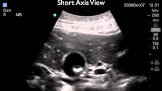 How To Gallbladder Ultrasound Part 2  Gallstones Case Study Video [upl. by Abate]