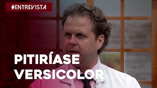 Tudo o que você precisa saber sobre Pitiríase Versicolor [upl. by Loram]