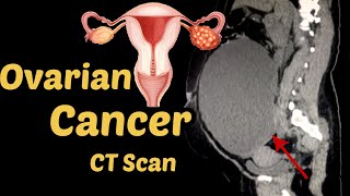 Ovarian Cancer Diagnosis CT Scan  Radiology [upl. by Kravits]