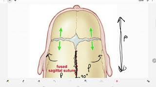 Craniosynostosis [upl. by Ameehsat]