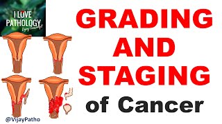 NEOPLASIA Part 11 GRADING and STAGING of cancer [upl. by Wenoa]