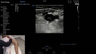 Tutorial EcoDoppler Vascular  Mapeamento do Sistema Venoso Membros Inferiores [upl. by Sebastiano]