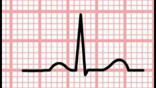 ECG Interpretation  Time and the ECG Section 1 Part 5 [upl. by Anyela]