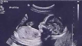 Ultrasound 20 Weeks 5 Months Pregnant Is it a Boy or a Girl [upl. by Monagan]