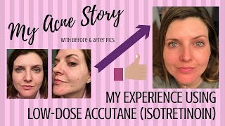 My Acne Story and Experience Using LowDose Accutane isotretinoin [upl. by Morette867]