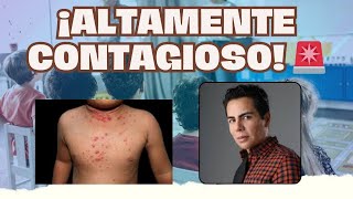 MOLUSCO CONTAGIOSO EN MENORES I JAVIER DERMA [upl. by Neelhtac53]