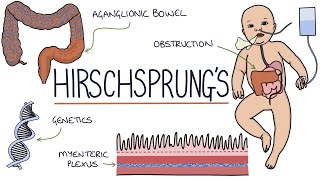 Hirschsprungs Disease [upl. by Av]