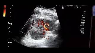 Pyelonephritis Focal acute pyelonephritisultrasound medicine mbbs doctor [upl. by Einama]