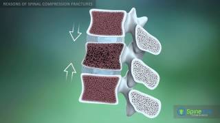 Spinal Compression Fracture Reasons [upl. by Trebor]