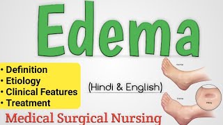 Edema  Edema In Hindi  Oedema [upl. by Arral]